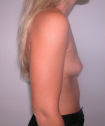 Breast Augmentation