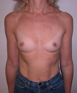 Breast Augmentation Before Photo Breast Augmentation