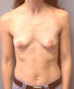 Breast Augmentation Before Photo Breast Augmentation