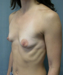 Breast Augmentation