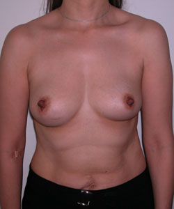 Breast Augmentation