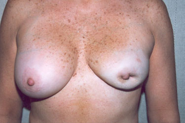 Breast Augmentation