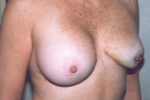 Breast Augmentation