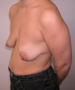 Breast Augmentation and Lift