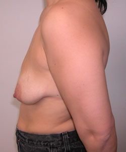 Breast Augmentation and Lift