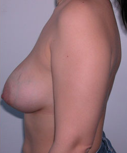 Breast Augmentation and Lift