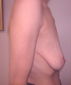 Breast Augmentation and Lift Before Photo Breast Augmentation and Lift