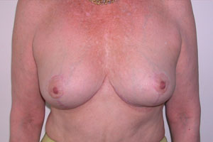 Breast Lift After Photo Breast Lift
