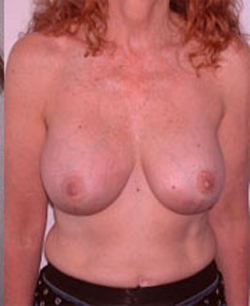 Breast Lift After Photo Breast Lift