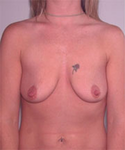 Breast Lift Before Photo Breast Lift