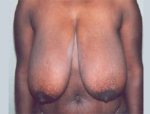 Breast Reduction for Women