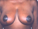 Breast Reduction for Women