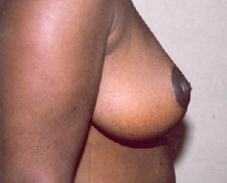 Breast Reduction for Women