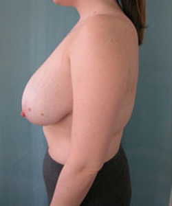 Breast Reduction for Women