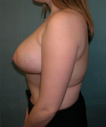 Breast Reduction for Women