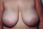 Breast Reduction for Women