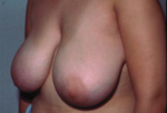 Breast Reduction for Women