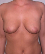 Breast Reduction for Women