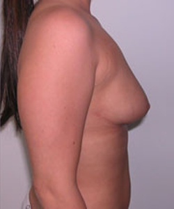 Breast Reduction for Women