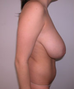 Breast Reduction for Women