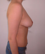 Breast Reduction for Women