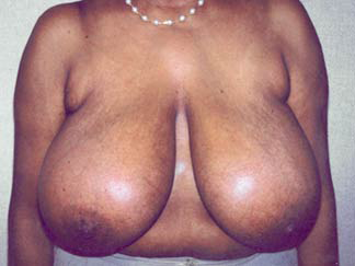 Breast Reduction for Women Before Photo Breast Reduction for Women