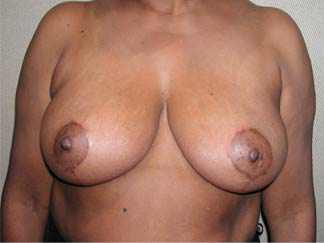 Breast Reduction for Women After Photo Breast Reduction for Women