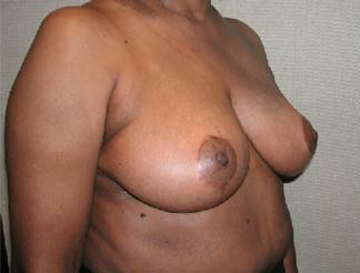 Breast Reduction for Women