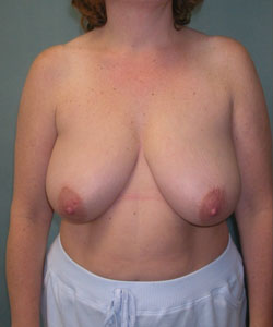 Breast Reduction for Women Before Photo Breast Reduction for Women