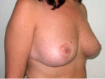 Breast Reduction for Women