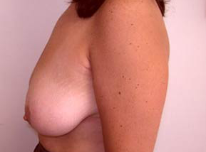 Breast Reduction for Women