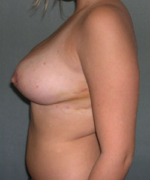 Breast Reduction for Women