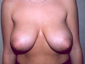 Breast Reduction for Women Before Photo Breast Reduction for Women