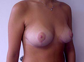 Breast Reduction for Women