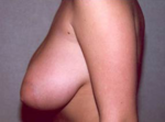 Breast Reduction for Women