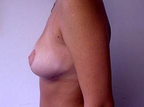 Breast Reduction for Women