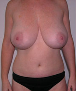 Breast Reduction for Women Before Photo Breast Reduction for Women