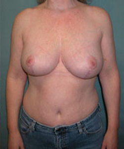 Breast Reduction for Women After Photo Breast Reduction for Women