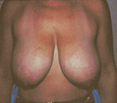 Breast Reduction for Women Before Photo Breast Reduction for Women