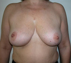 Breast Reduction for Women After Photo Breast Reduction for Women