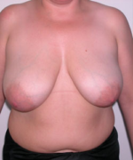 Breast Reduction for Women