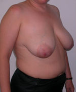 Breast Reduction for Women