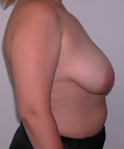 Breast Reduction for Women