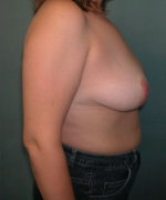 Breast Reduction for Women