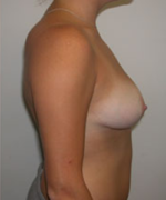 Breast Reduction for Women