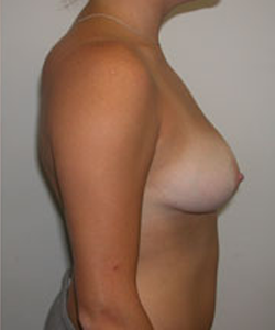 Breast Reduction for Women After Photo Breast Reduction for Women