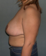 Breast Reduction for Women