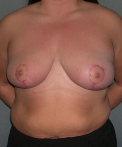 Breast Reduction for Women After Photo Breast Reduction for Women