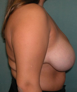 Breast Reduction for Women