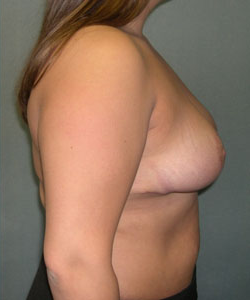 Breast Reduction for Women